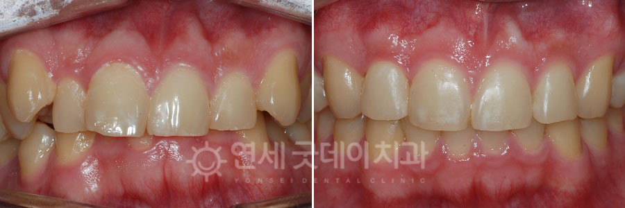 딥바이트 전체 치아교정 전후 비교 모습이며 1년 3개월의 교정치료 후 개선됨