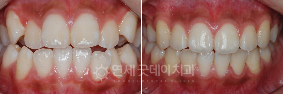 성장기 치아교정 전후 정면모습을 비교하였습니다