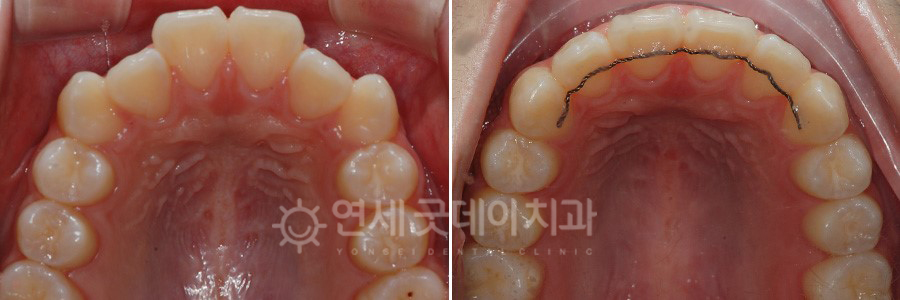 성장기 치아교정 전후 상악 비교 모습