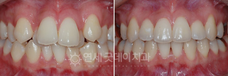 비발치교정을 통한 성장기 치아교정 전후 비교 모습 - 정면