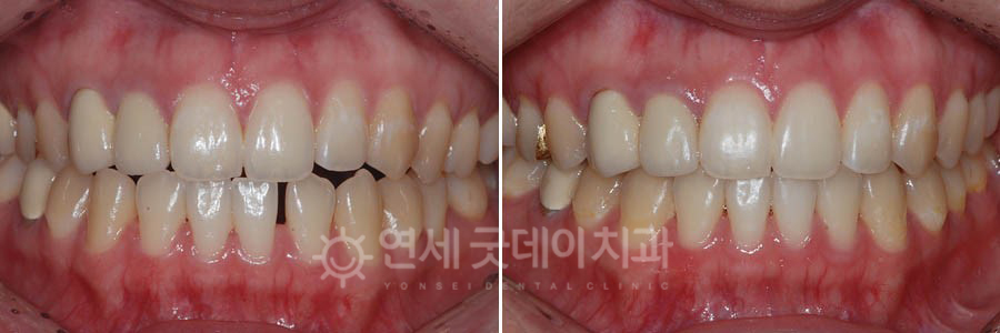 전체교정을 통한 벌어진치아 교정 전후 비교 모습