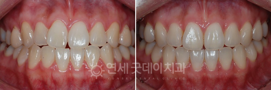 틀어진앞니 치아교정 전후 비교 모습