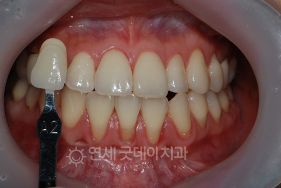전문가 치아미백 치료 전 모습