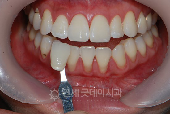전문가 치아미백 치료 후 모습