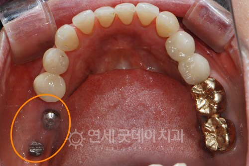 어금니 임플란트 치료 진행 중인 모습