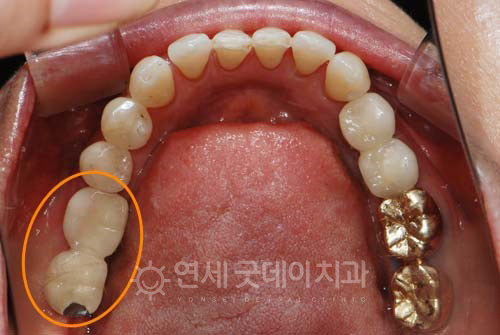 어금니 임플란트 치료 완료 후 모습
