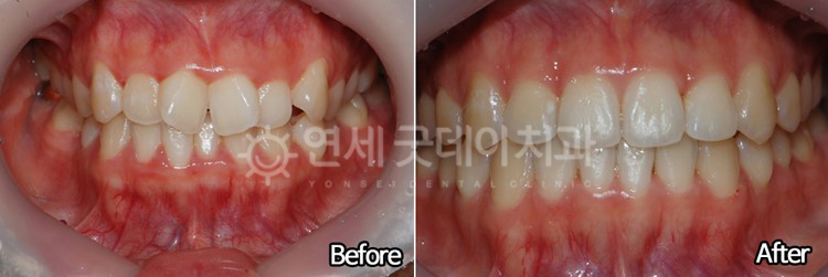 덧니교정 전후 비교 모습 (정면)
