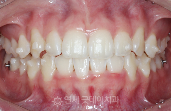 인비절라인교정