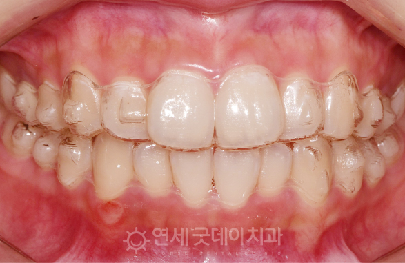인비절라인교정
