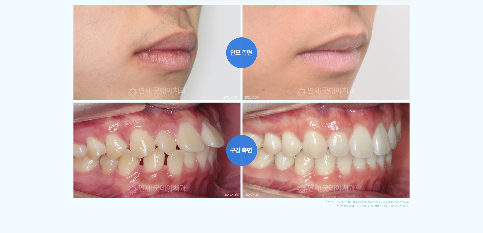 인비절라인교정
