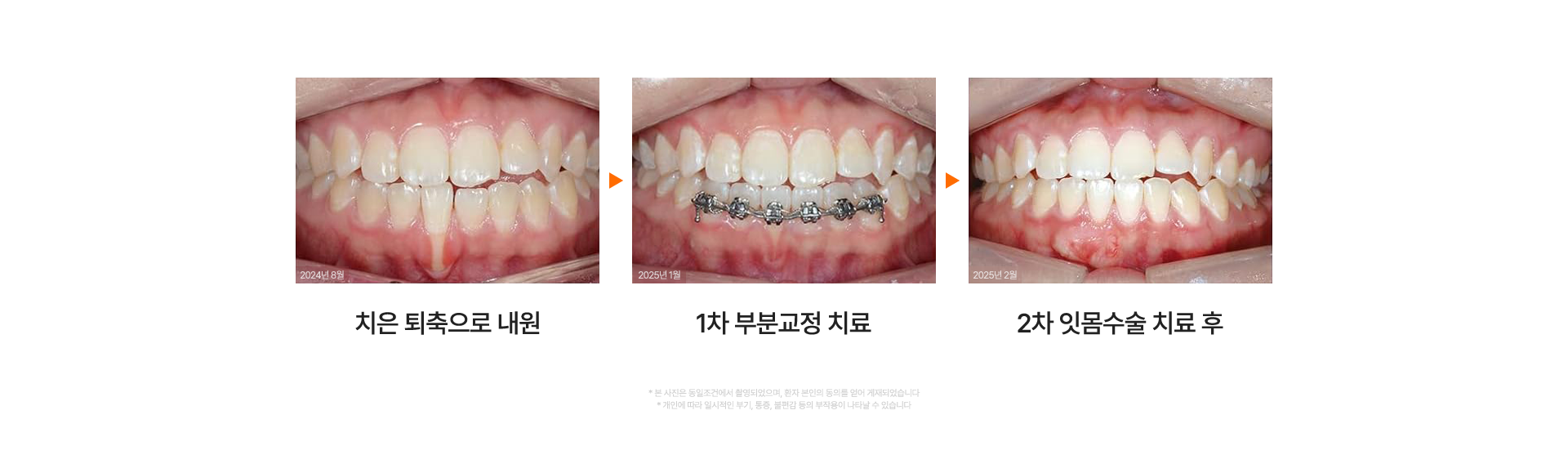 연세굿데이치과의 중장년층을 위한 맞춤 치주교정 솔루션 소개.