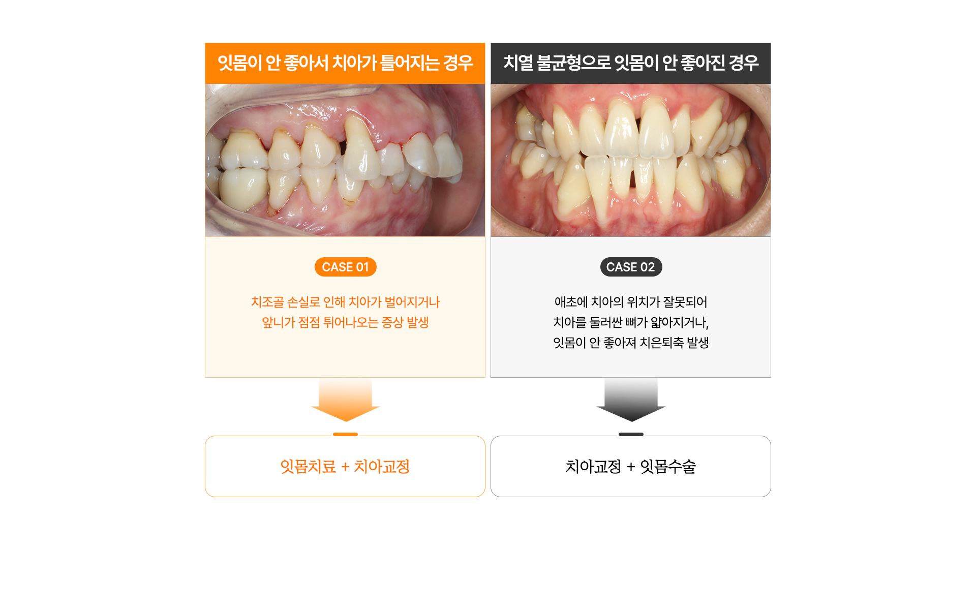 중장년층 치주교정에서 잇몸치료와 교정수술 방법을 비교 설명하는 도식.