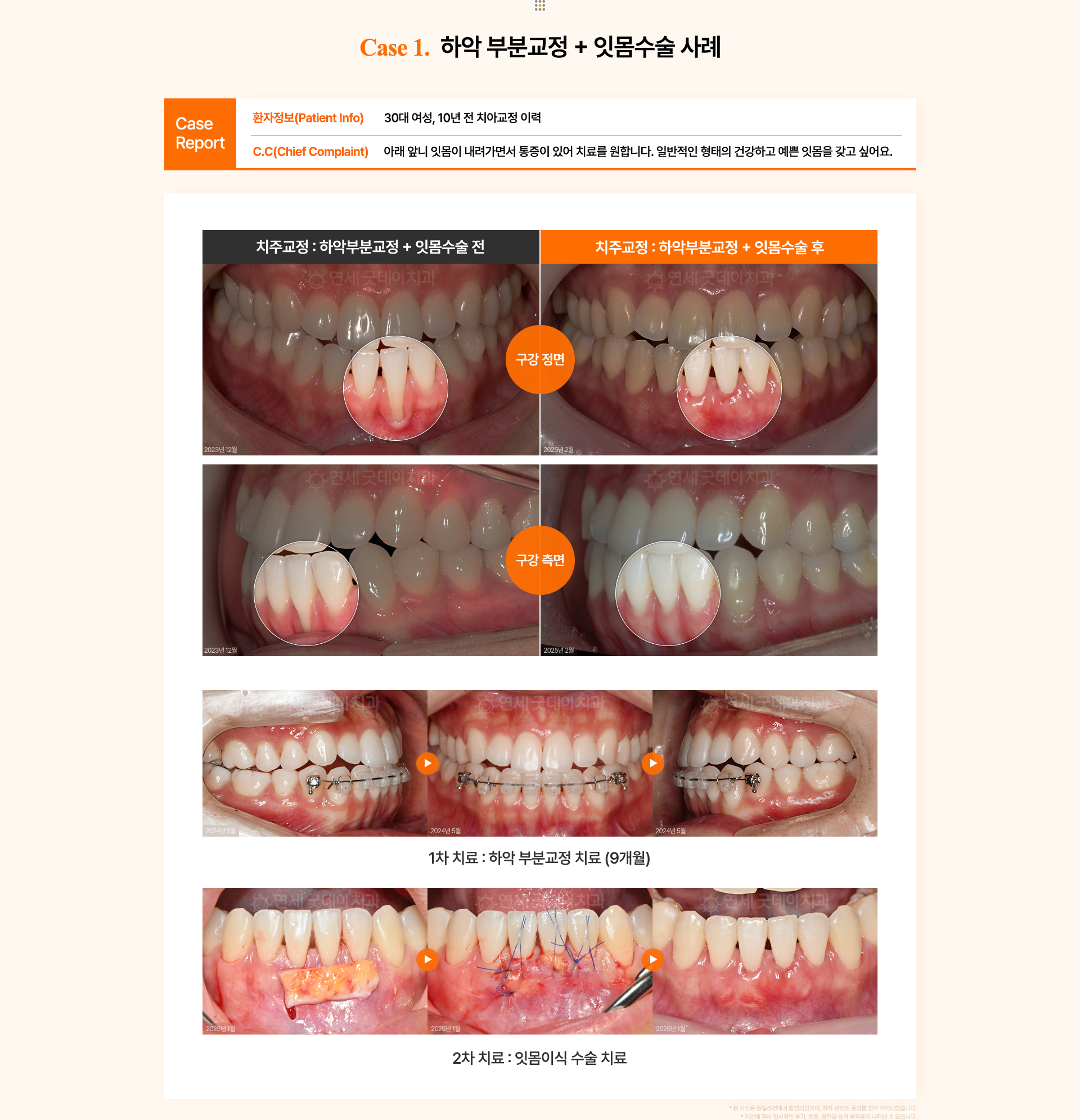 30대 여성의 잇몸이 심하게 내려간 아래 앞니를 하악 부분교정과 잇몸이식으로 개선한 치주교정 전후 비교.