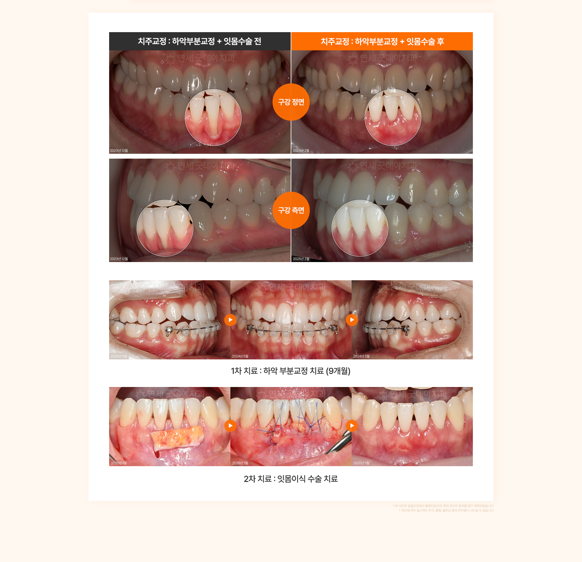 30대 여성의 잇몸이 심하게 내려간 아래 앞니를 하악 부분교정과 잇몸이식으로 개선한 치주교정 전후 비교.