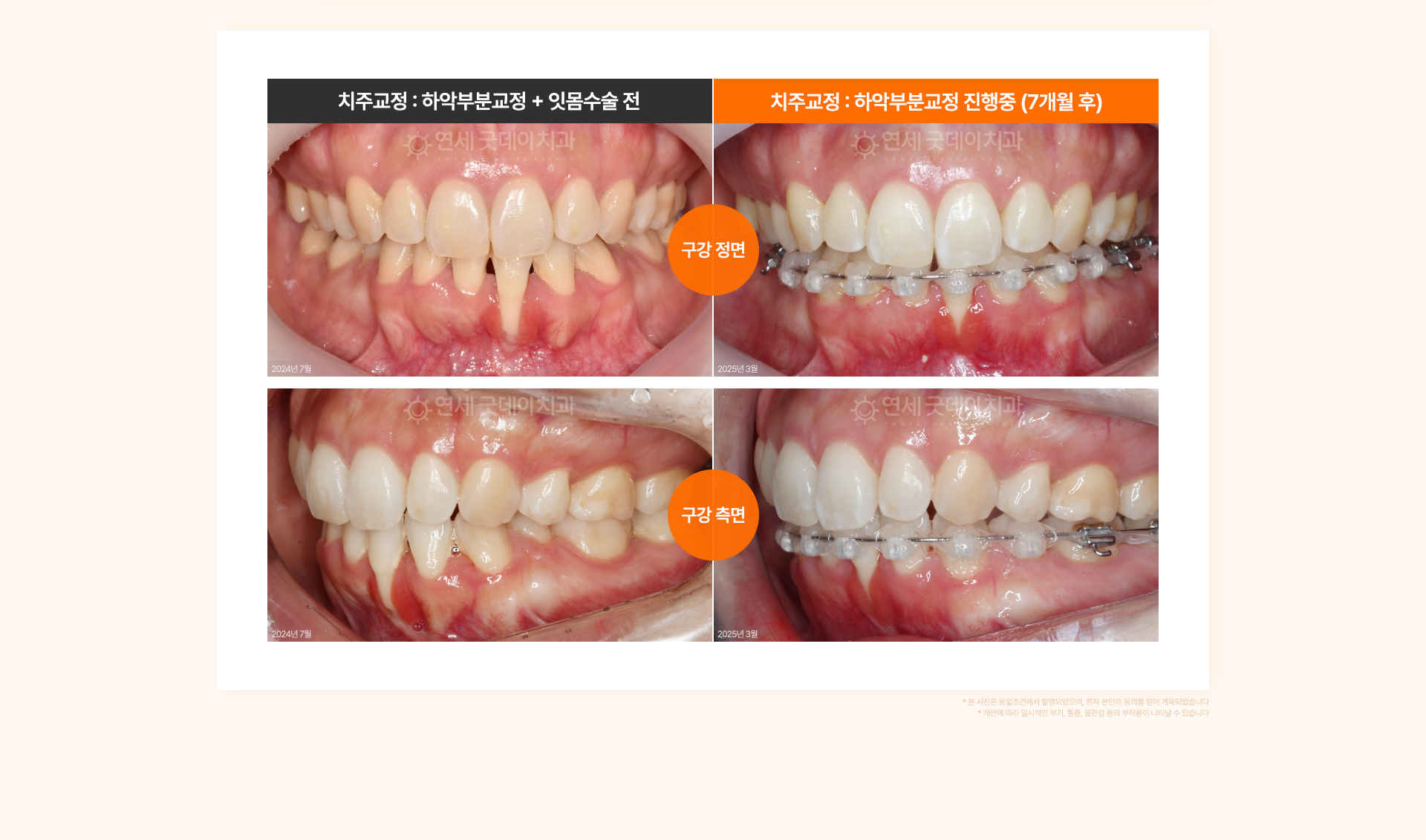 30대 여성의 잇몸 퇴축으로 치아 뿌리가 노출된 상태를 하악 부분교정으로 70% 개선한 치주교정 사례.