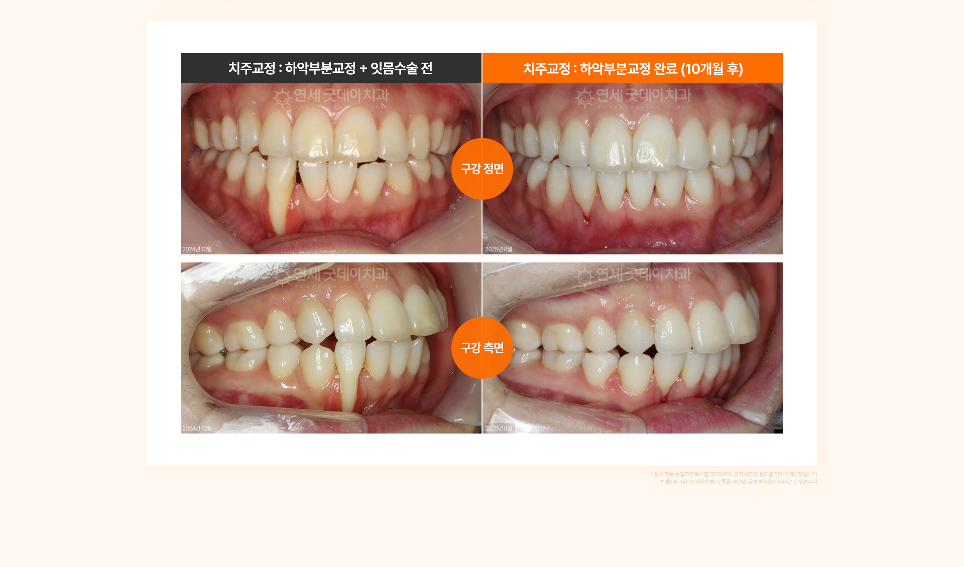 30대 여성의 회전된 아래 측절치와 잇몸 퇴축 문제를 하악 부분교정과 잇몸치료로 개선한 치주교정 전후 비교.