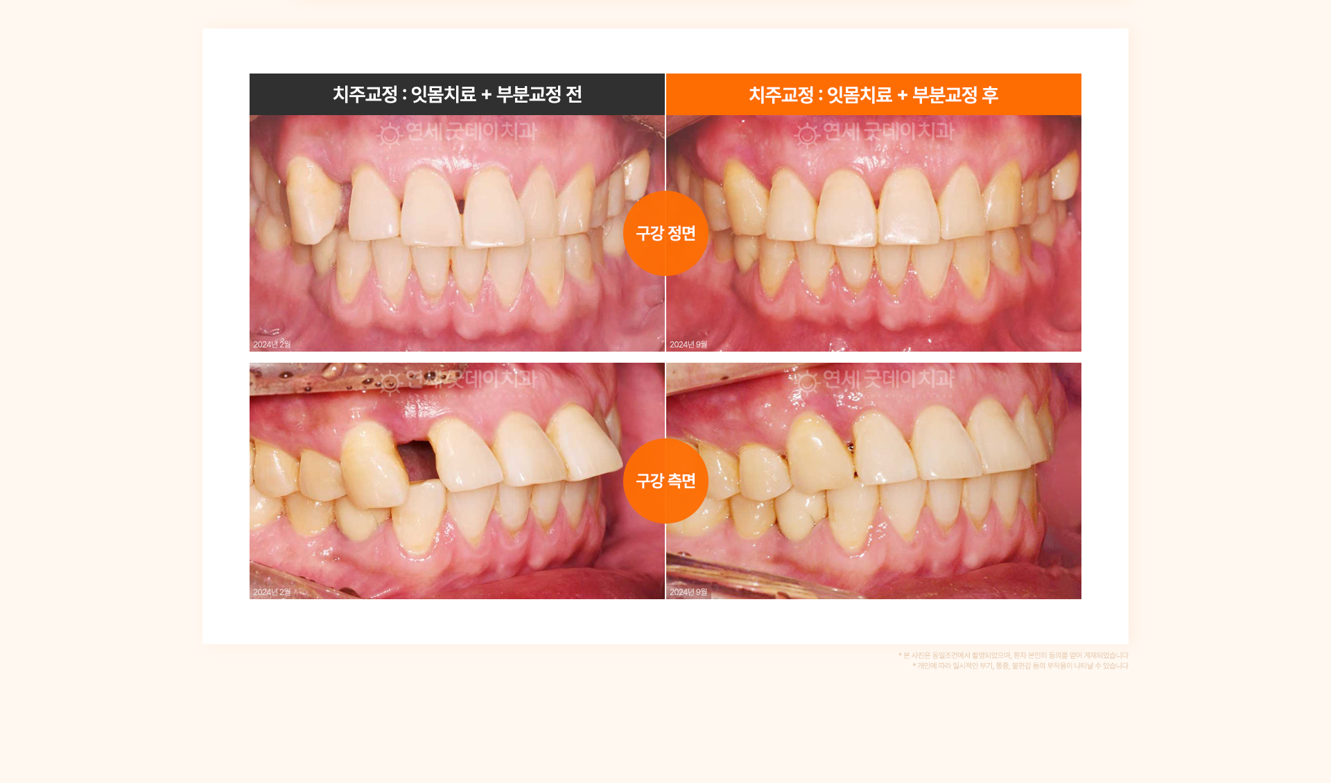 50대 남성의 벌어진 송곳니와 잇몸 문제를 잇몸치료와 상악 부분교정으로 정상 배열로 회복시킨 치주교정 사례.