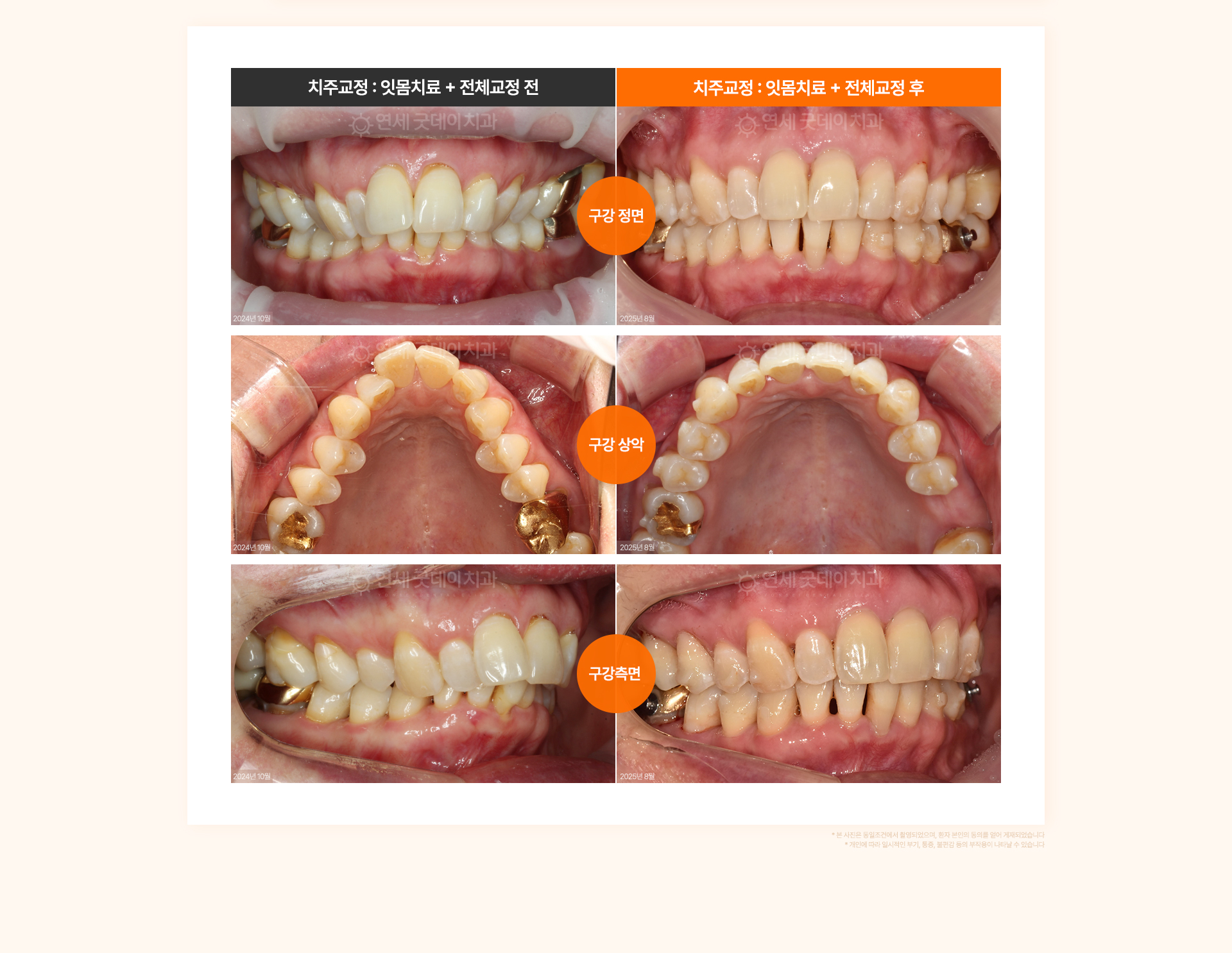 50대 여성의 좁은 악궁과 안쪽으로 기운 치열을 잇몸치료 후 전체교정으로 개선한 치주교정 전후 비교.
