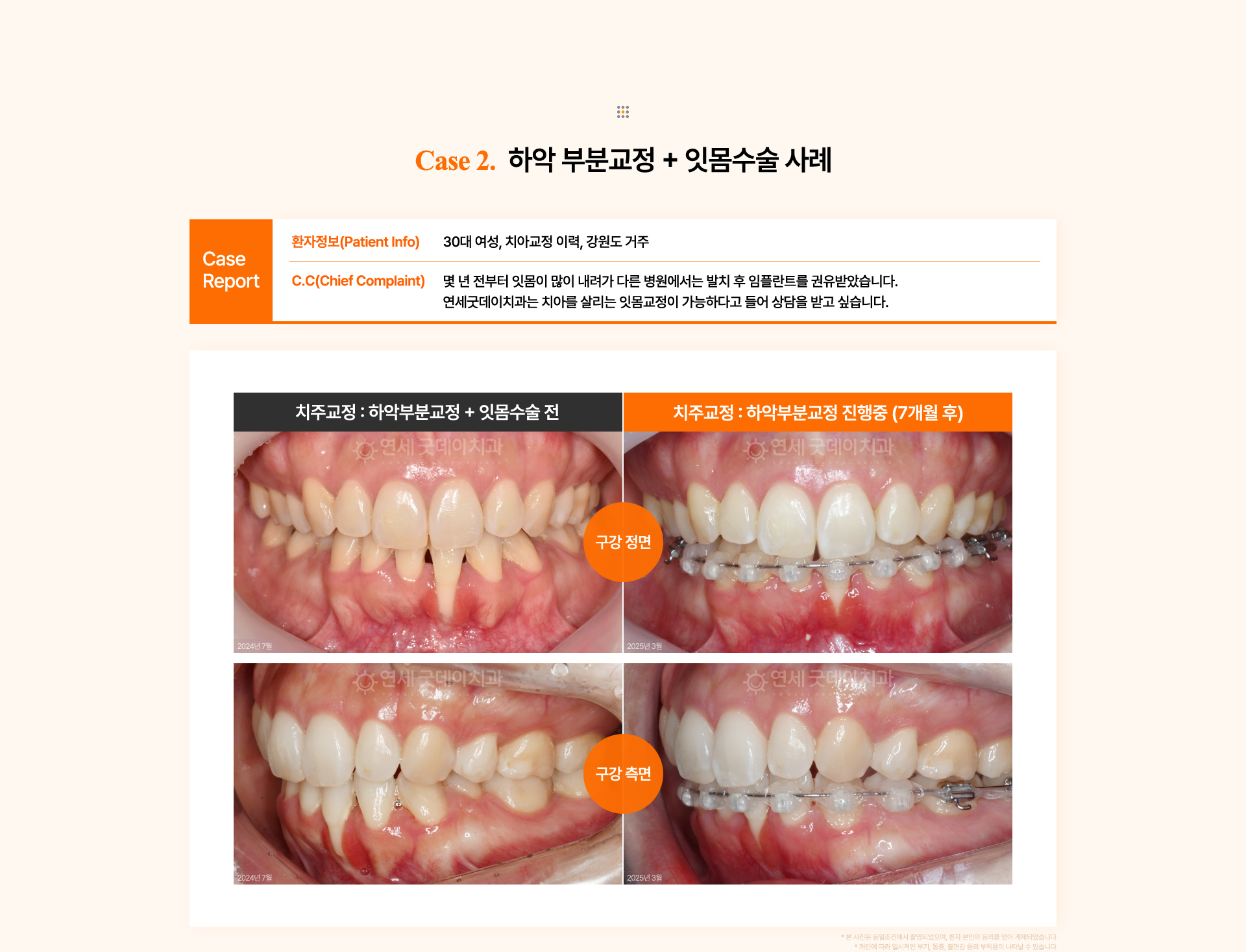 30대 여성의 잇몸 퇴축으로 치아 뿌리가 노출된 상태를 하악 부분교정으로 70% 개선한 치주교정 사례.