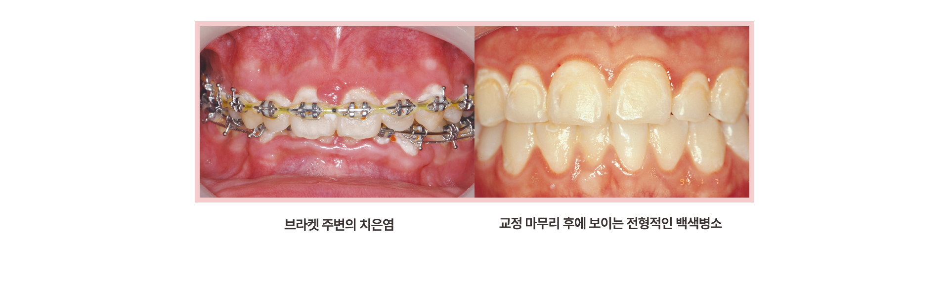 교정치료 중 발생하는 치은염과 백색병소