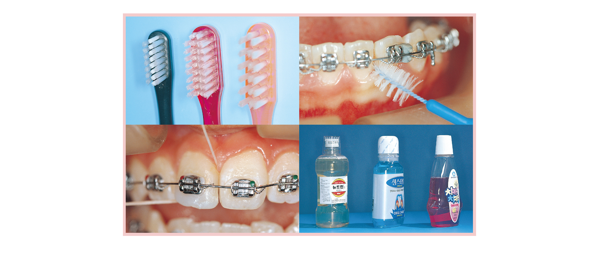 교정치료 중 발생하는 치은염과 백색병소 예방을 위한 칫솔, 치간칫솔, 치실, 가글 등 구강위생관리 도구 안내.