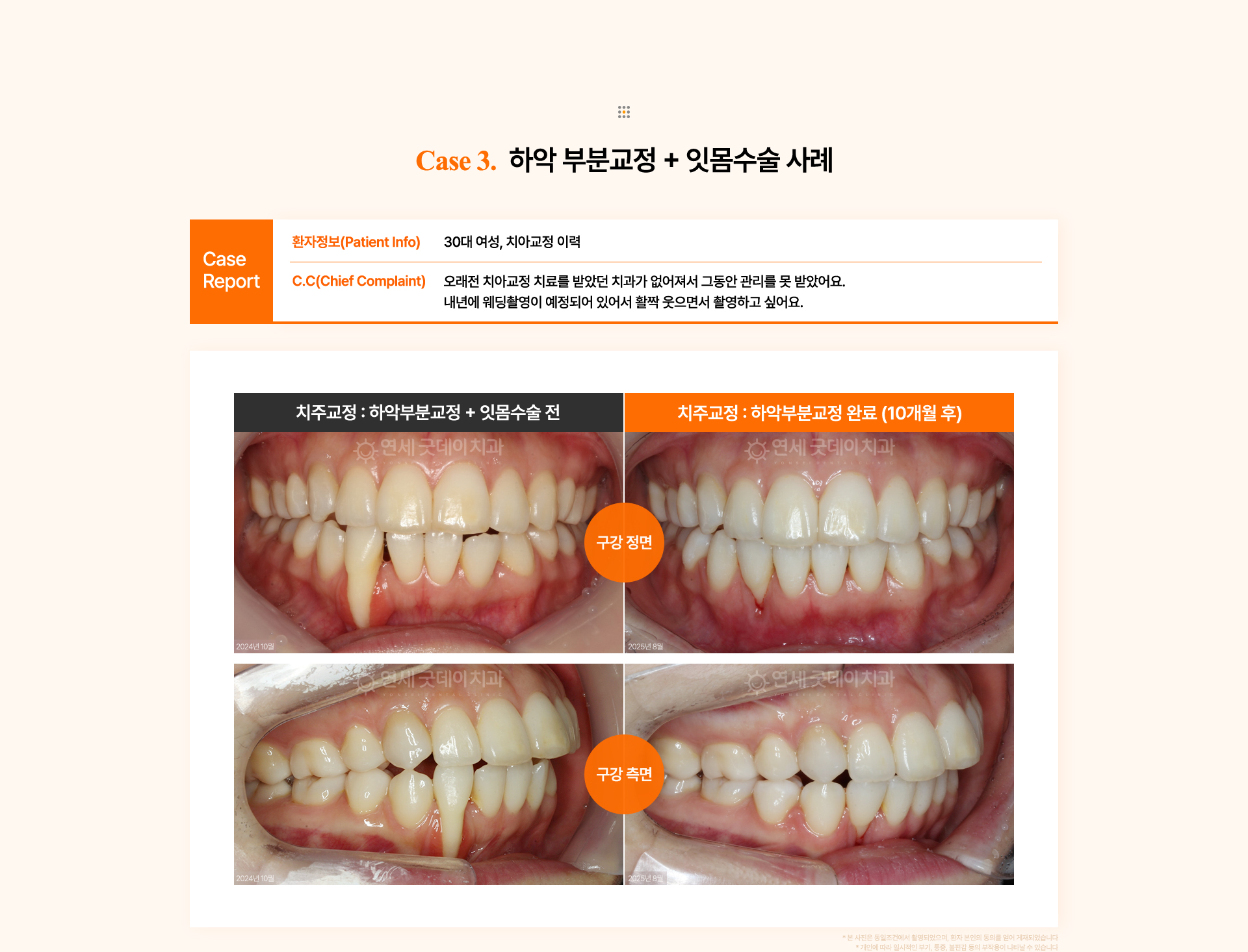 30대 여성의 회전된 아래 측절치와 잇몸 퇴축 문제를 하악 부분교정과 잇몸치료로 개선한 치주교정 전후 비교.