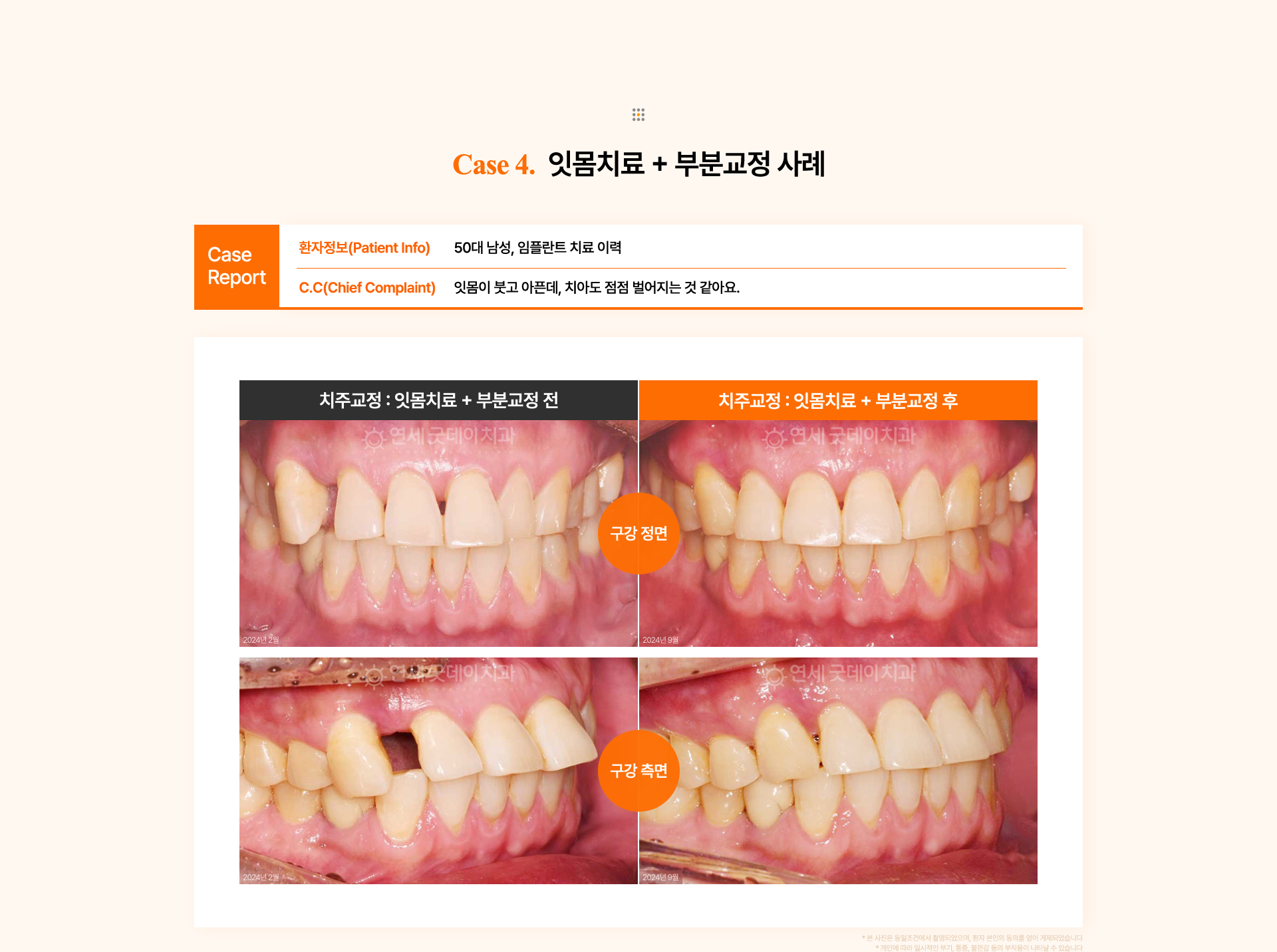 50대 남성의 벌어진 송곳니와 잇몸 문제를 잇몸치료와 상악 부분교정으로 정상 배열로 회복시킨 치주교정 사례.