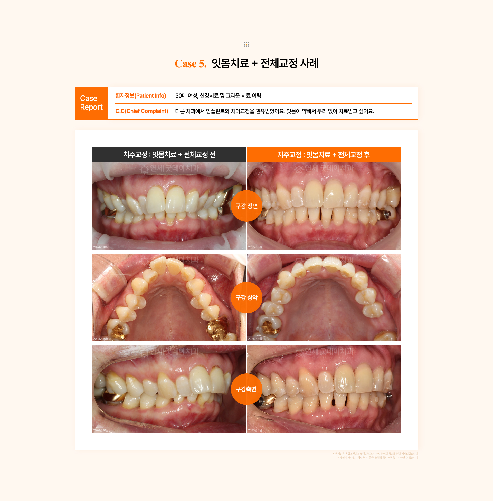 50대 여성의 좁은 악궁과 안쪽으로 기운 치열을 잇몸치료 후 전체교정으로 개선한 치주교정 전후 비교.