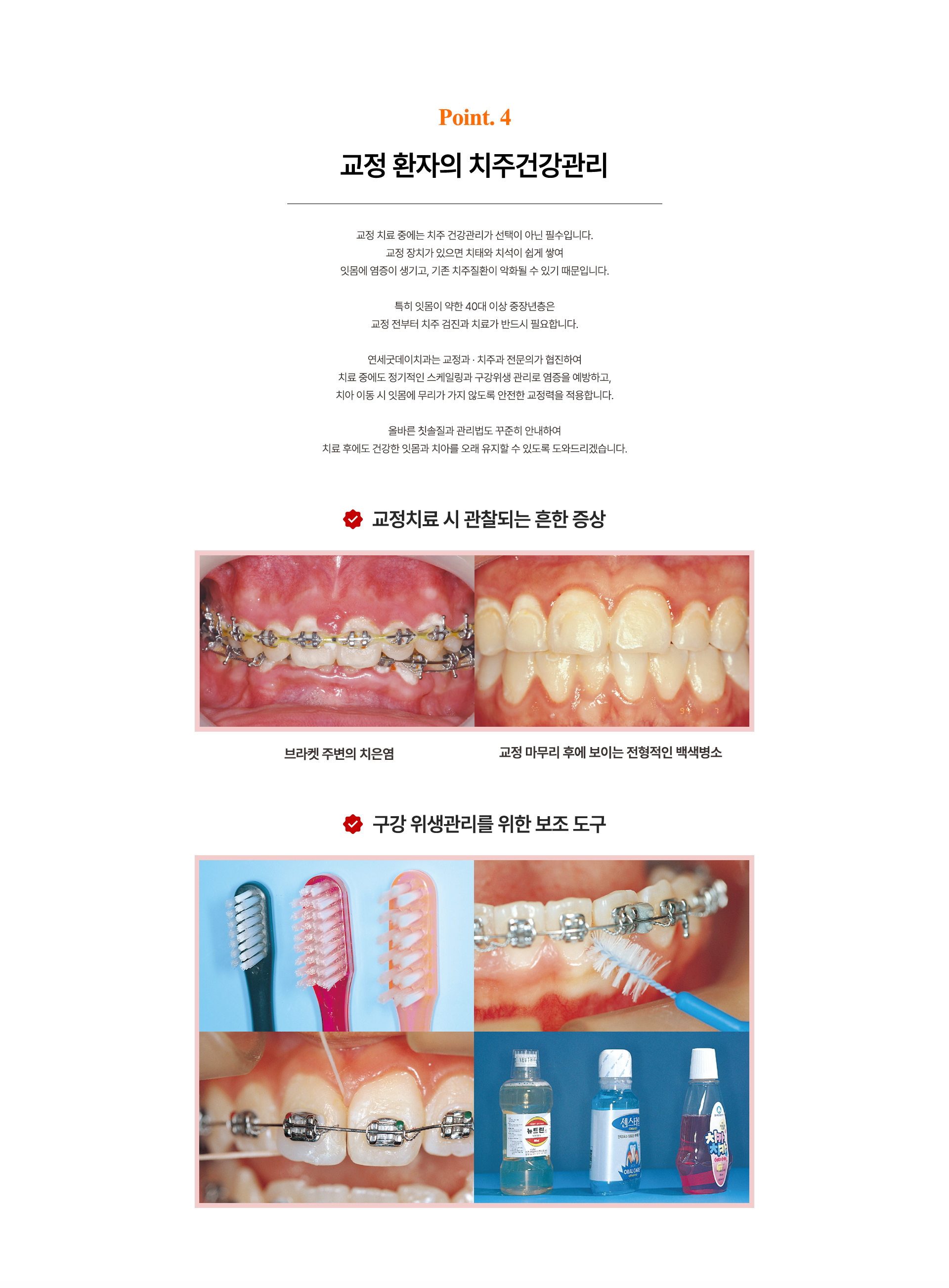 교정치료 중 발생하는 치은염과 백색병소 예방을 위한 칫솔, 치간칫솔, 치실, 가글 등 구강위생관리 도구 안내.