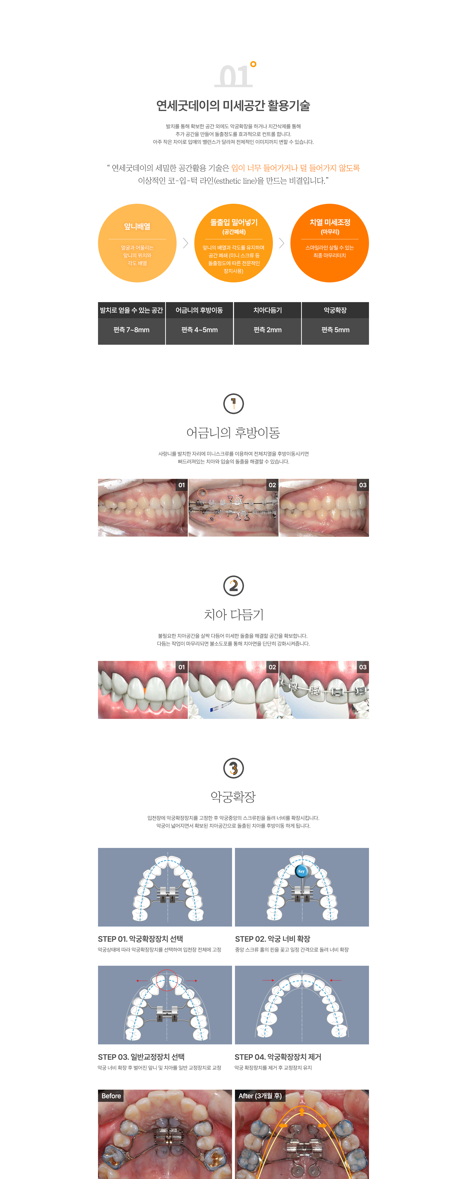 돌출입/잇몸돌출