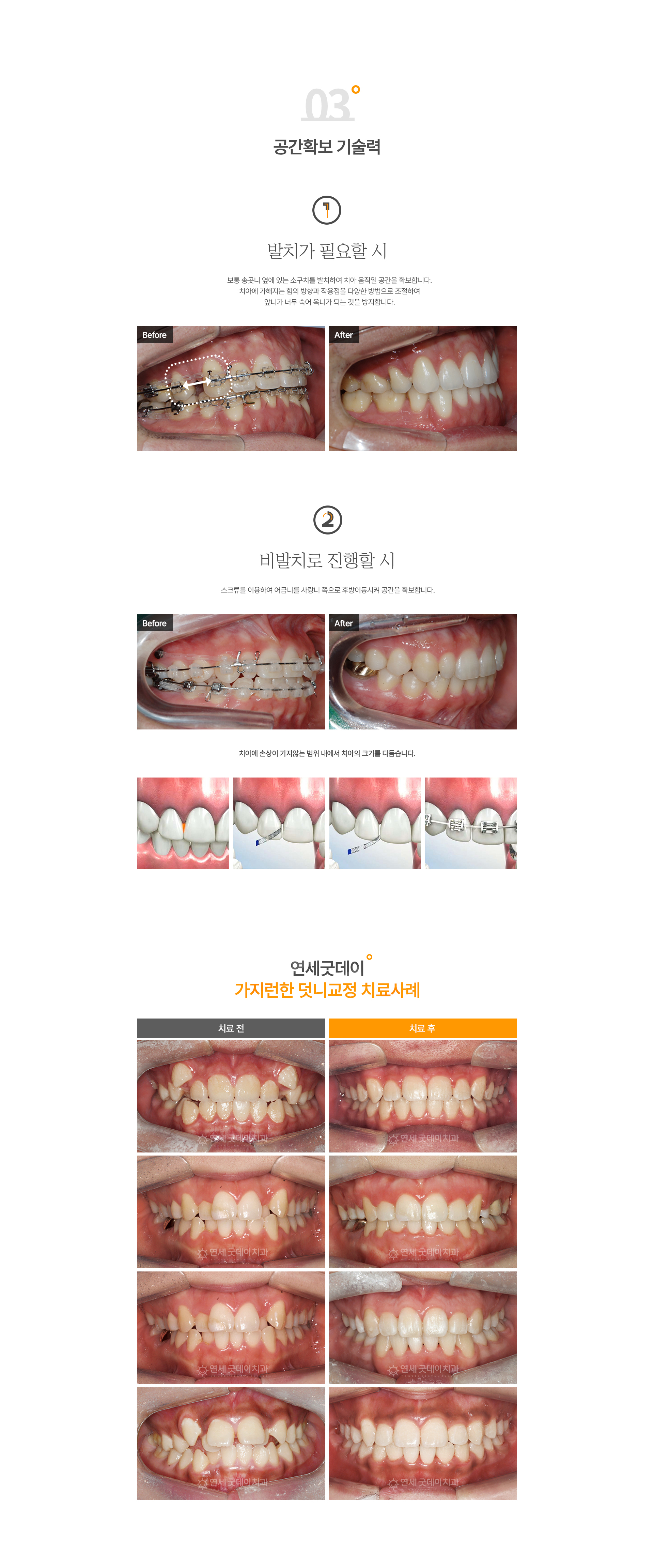 삐뚤빼뚤한덧니