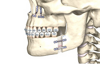 개방교합 턱관절교정