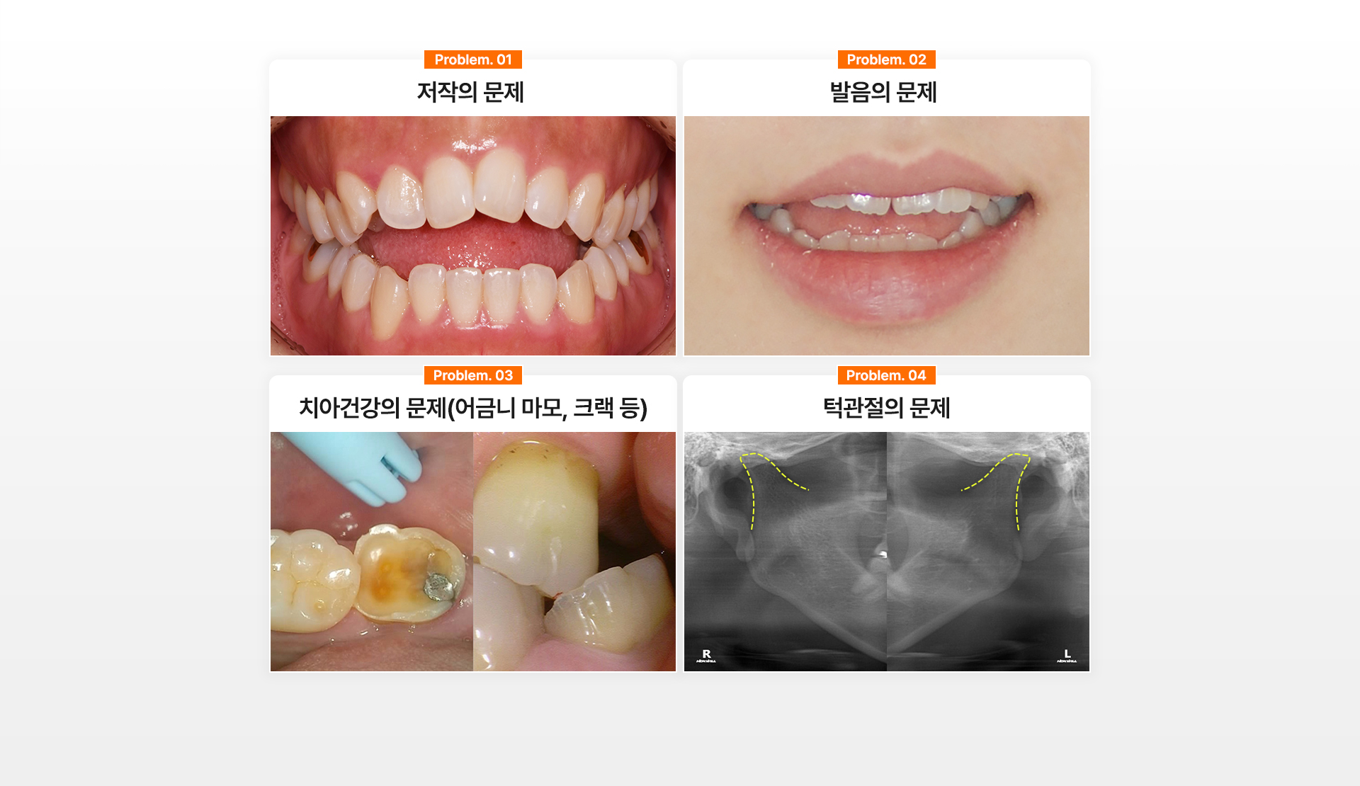 개방교합 턱관절교정