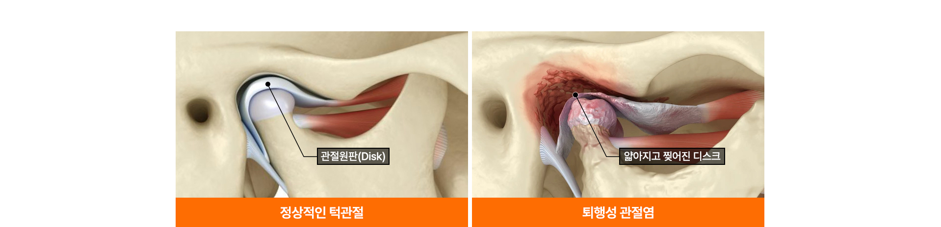 개방교합 턱관절교정
