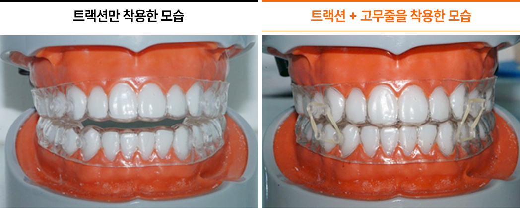 개방교합 턱관절교정