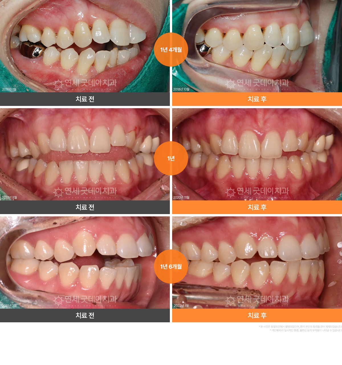 개방교합 턱관절교정