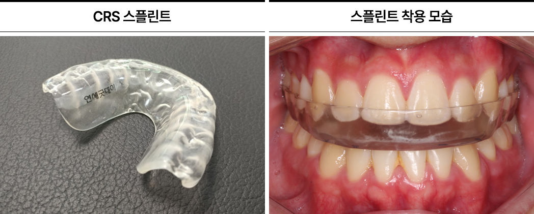 개방교합 턱관절교정