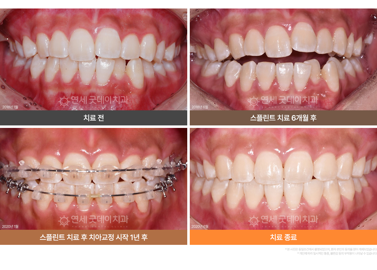 개방교합 턱관절교정