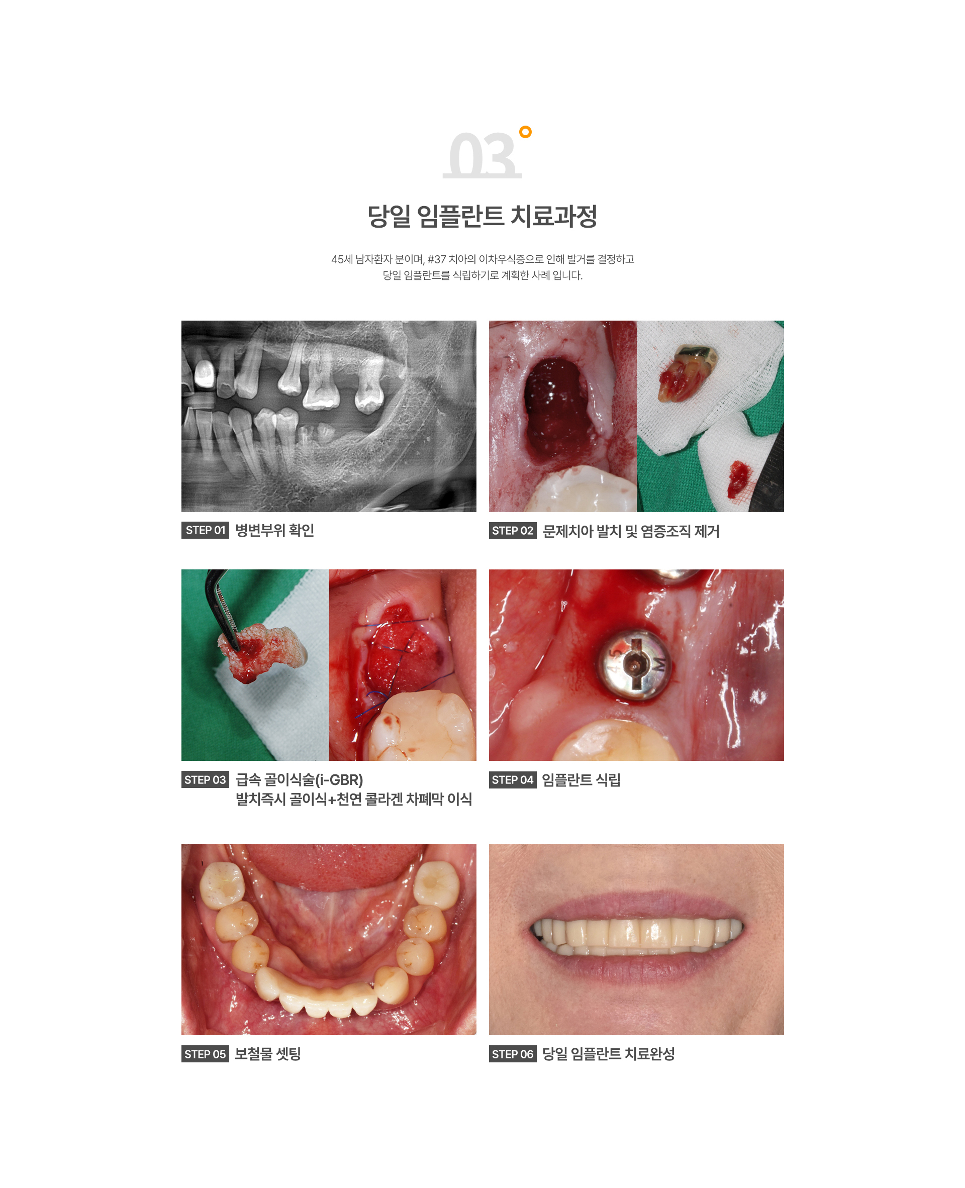 당일임플란트