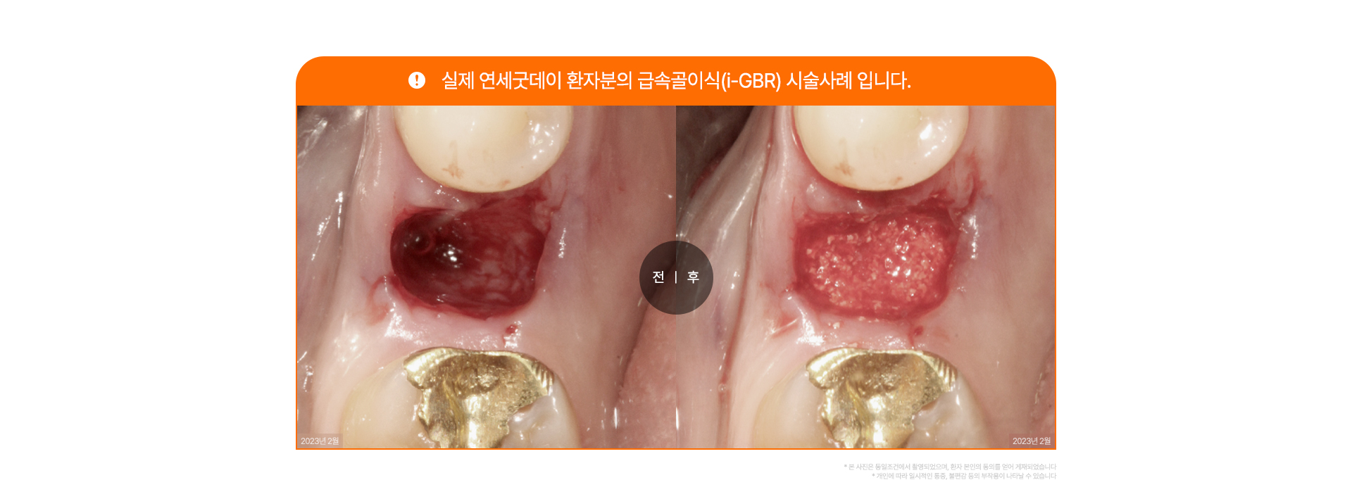 급속골이식(i-GBR)