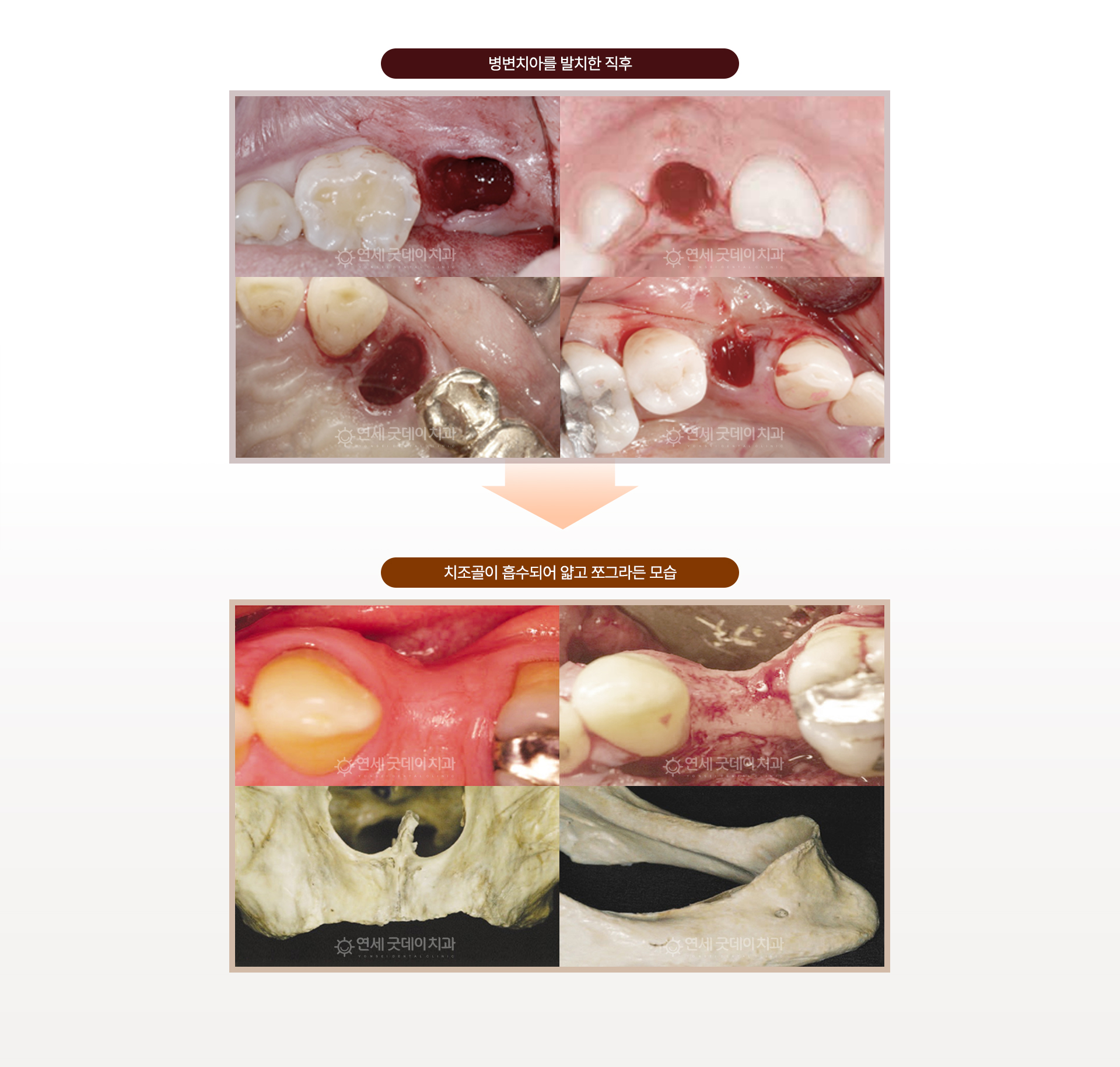 급속골이식(i-GBR)