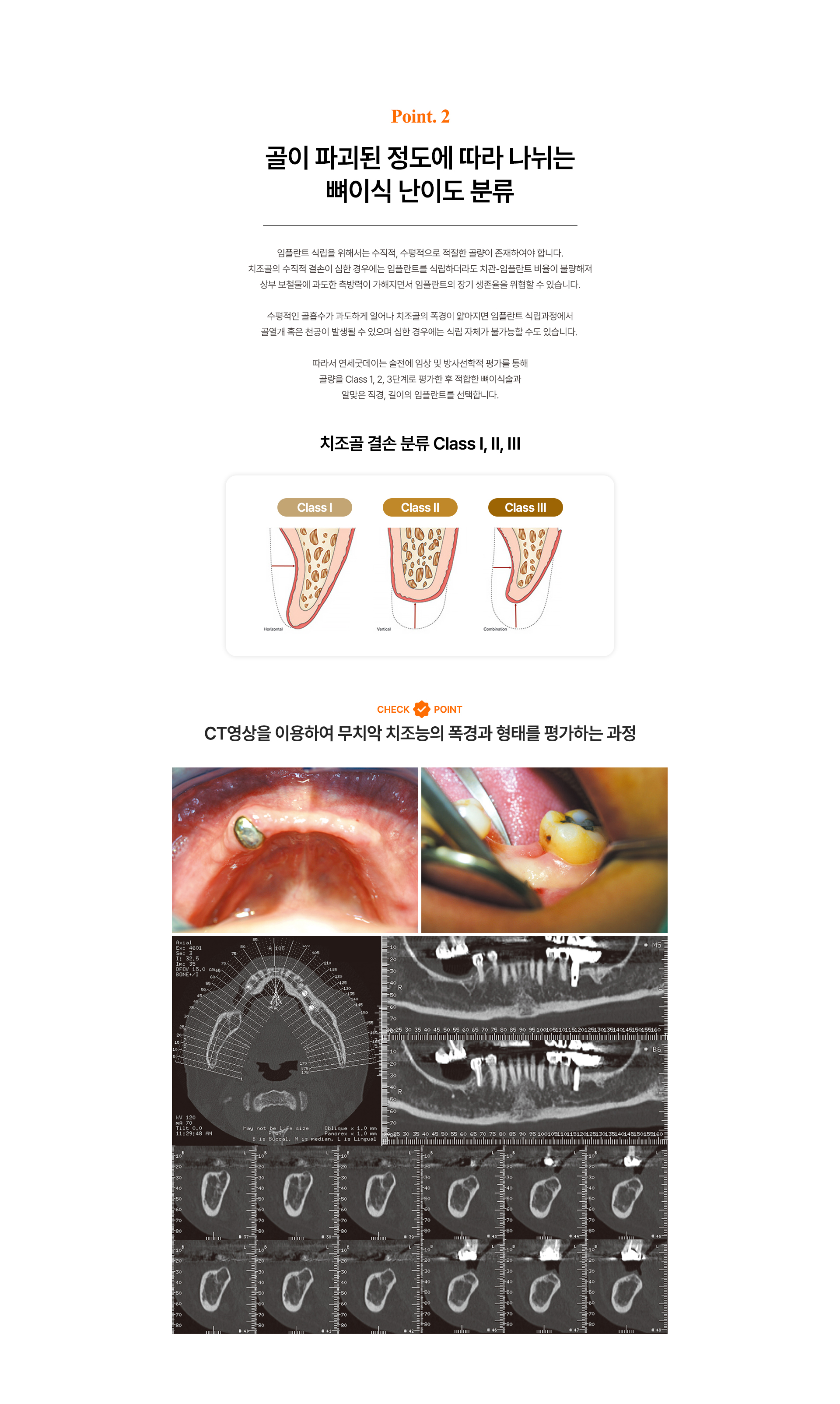 급속골이식(i-GBR)