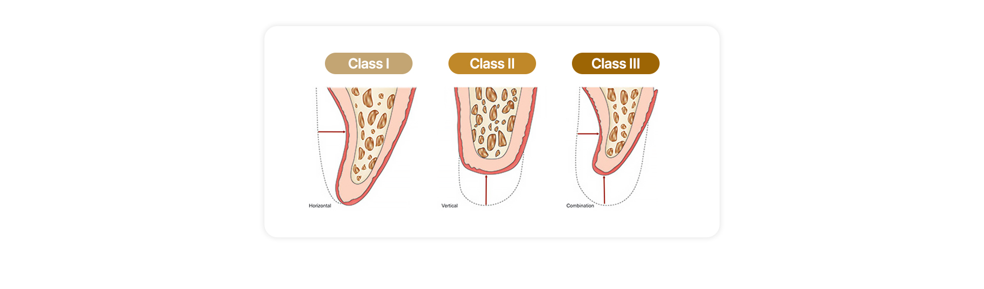 급속골이식(i-GBR)