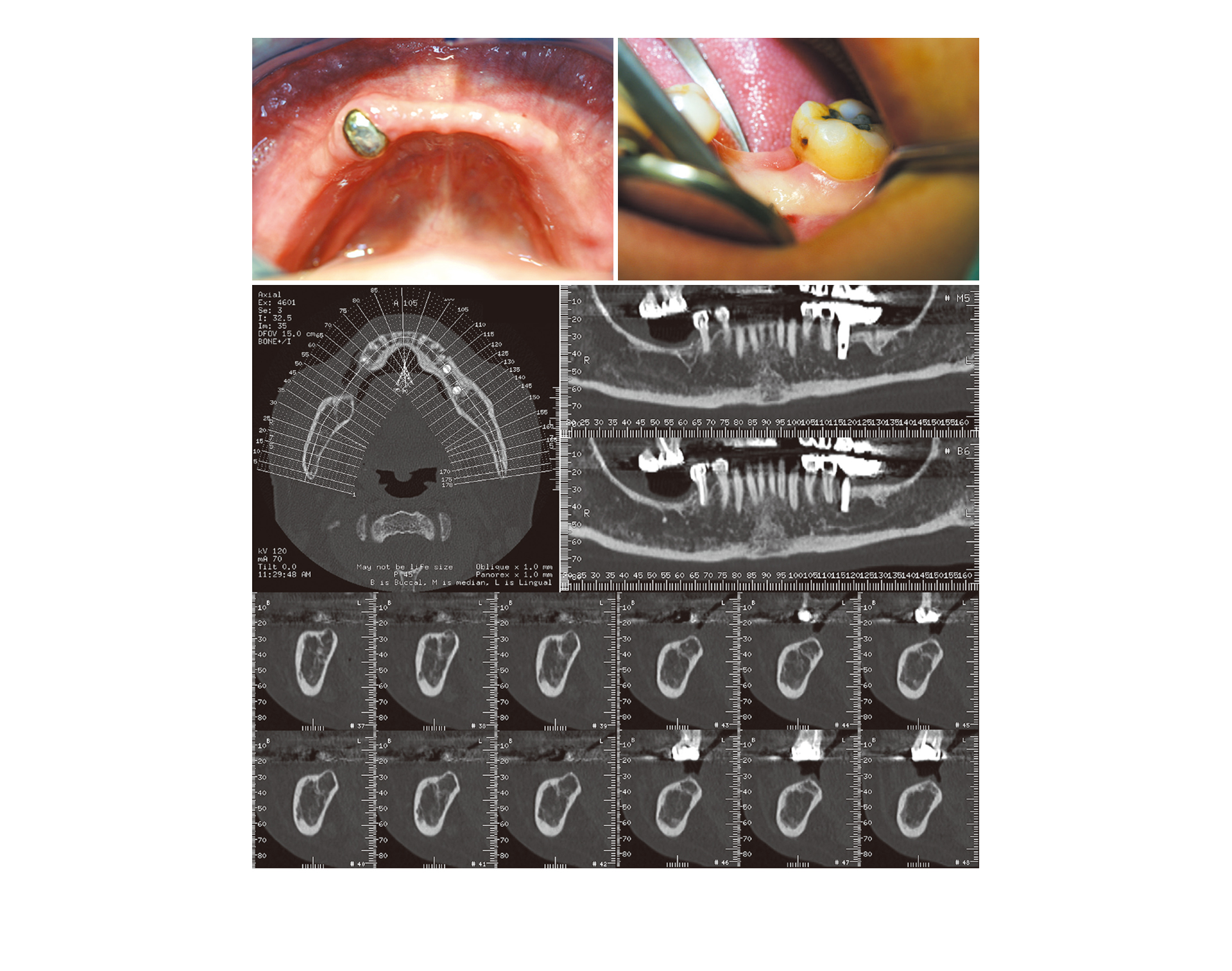 급속골이식(i-GBR)