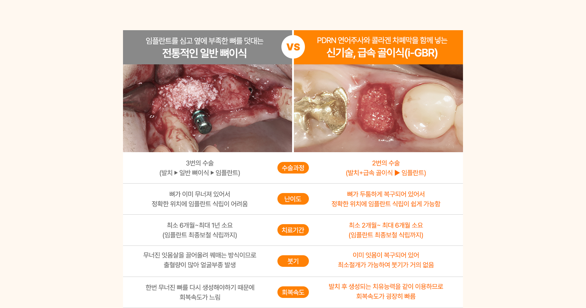 급속골이식(i-GBR)