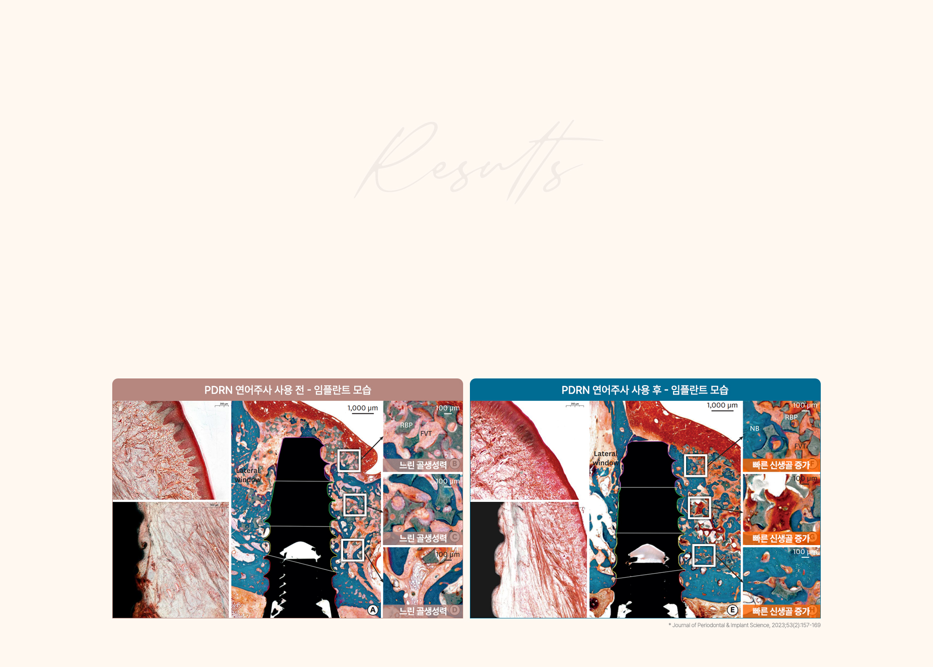 급속골이식(i-GBR)