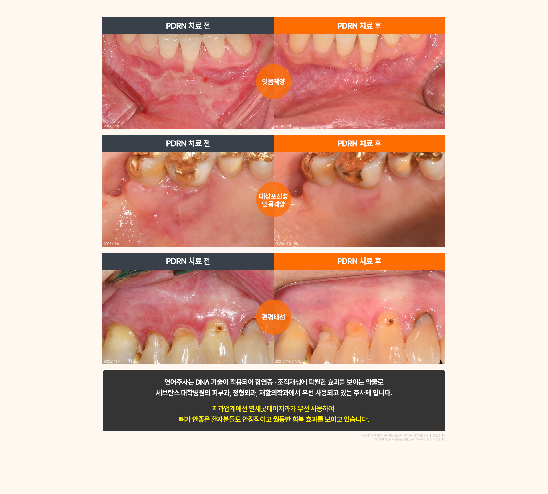 급속골이식(i-GBR)