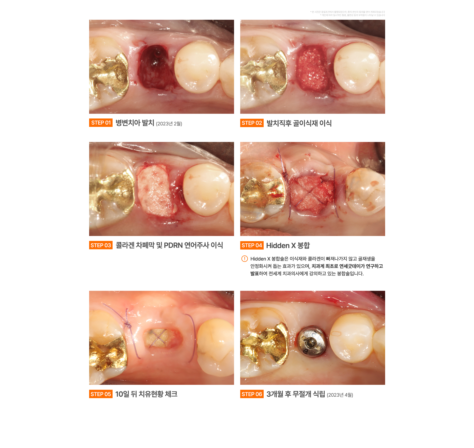 급속골이식(i-GBR)