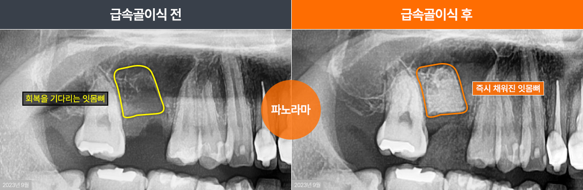 급속골이식(i-GBR)