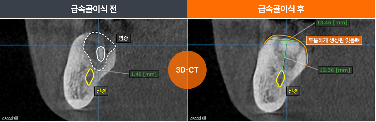 급속골이식(i-GBR)